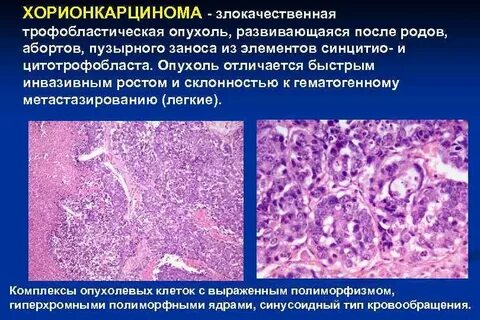 У женщины злокачественная опухоль