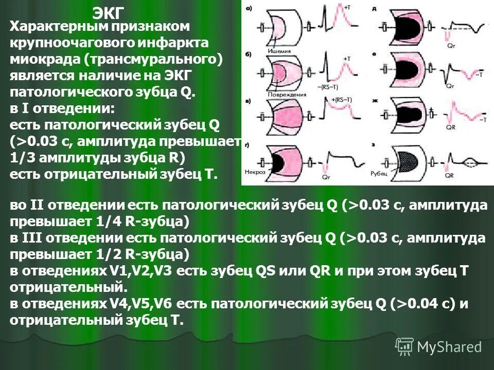 Клинические варианты течения острого периода инфаркта миокарда. Причиной инфаркта миокарда является. Основным признаком инфаркта является. Клинические симптомы инфаркта миокарда. Основным признаком инфаркта является.