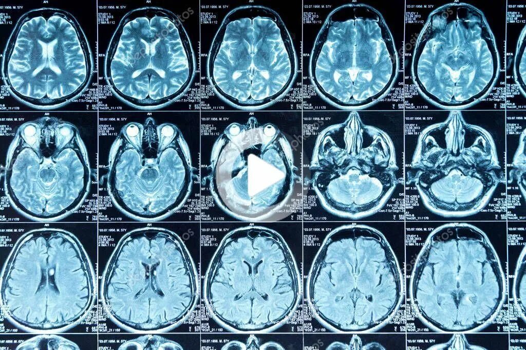 Кт снимок. Мрт мозга. Томография головы. Кт томограмма головного мозга.