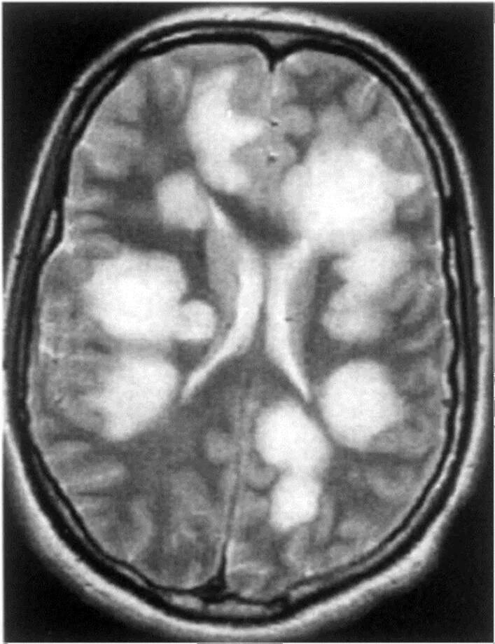 Демиелинизация головного. Демиелинизация головного мозга мрт. Концентрический склероз балло мрт. Острый рассеянный энцефаломиелит мрт. Демиелинизирующие заболевания головного мозга на мрт.