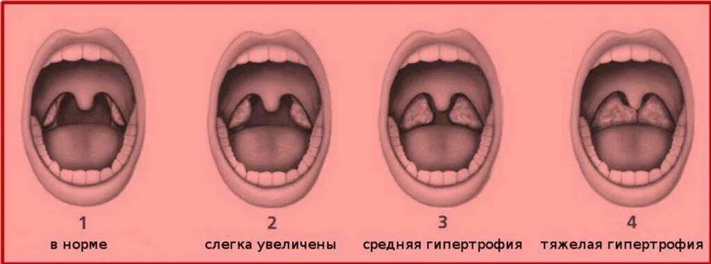 Аденоиды у ребенка 2 3 лет. Аденоиды 1-2 степени у детей 3 лет. Аденойды 3 степени Уребенка. Гипертрофия аденоиды 2 степени. : Гипертрофия аденоидов III степени..