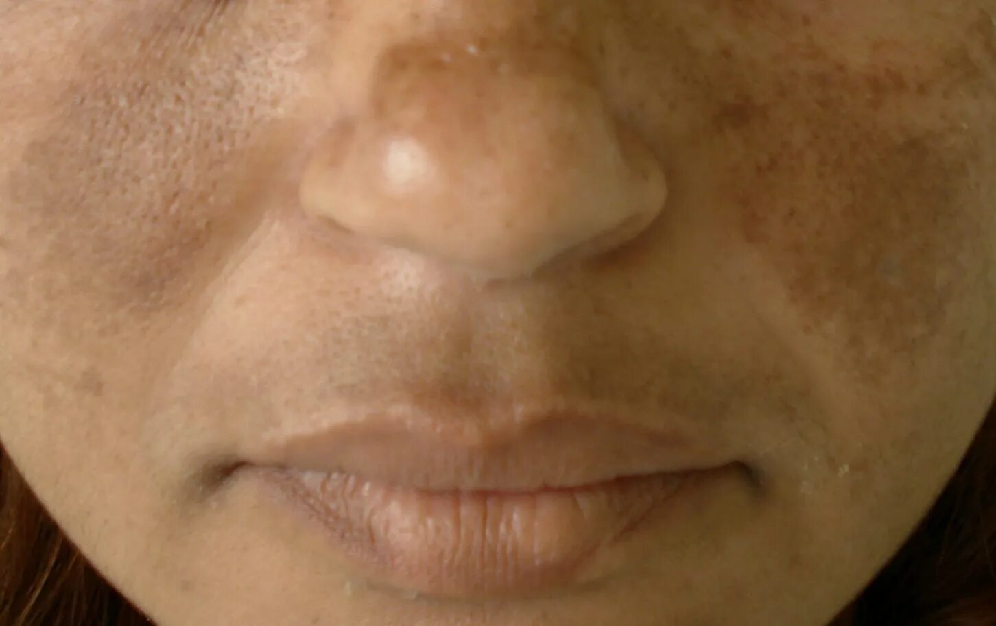 Причины сухости кожи и волос. Фрамбезийный гиперкератоз. Гиперпигментация меланин. Гиперпигментация мелазма. Гиперпигментация мелазма.