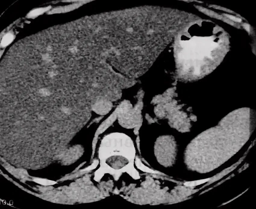 Гиповаскулярное образование в печени. Гиповаскулярные образования печени на кт. Гиподенсные очаги в печени по кт. Объемное образование печени на кт.