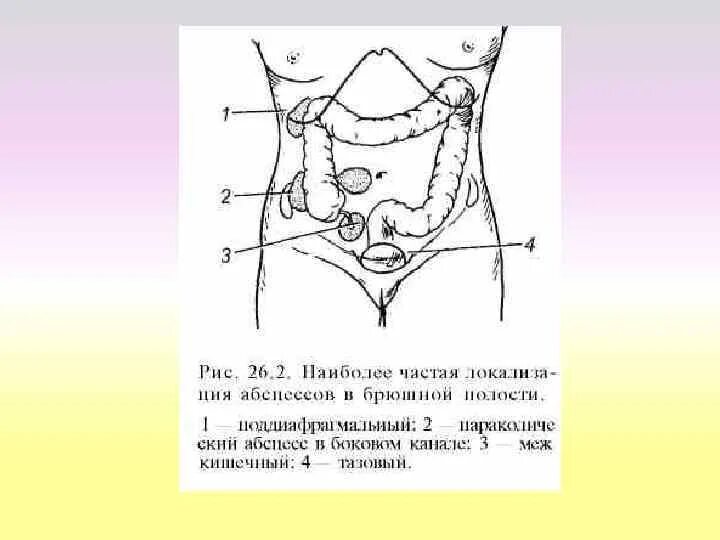 Межкишечный абсцесс брюшной полости. Внутрибрюшинные абсцессы. Типичные места локализации абсцессов в брюшной полости.