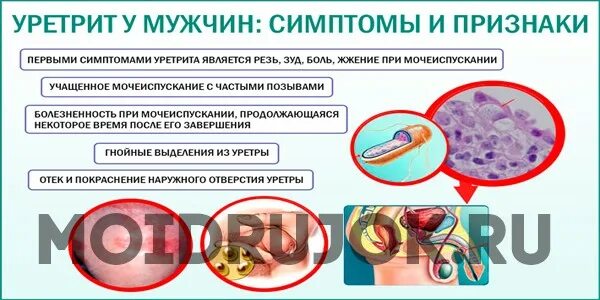 Бактериальный уретрит у мужчин. Бактериальный уретрит у мужчин