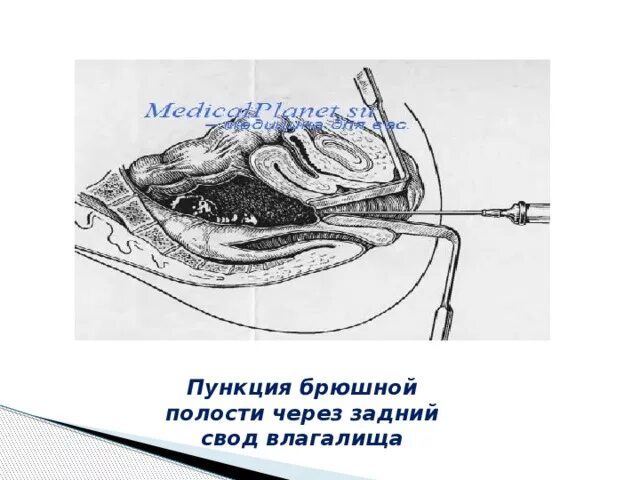 Пункция заднего свода матки. Кульдоцентез (пункция заднего свода).. Пункция заднего свода брюшной полости. Трансвагинальная пункция брюшной полости. Задний свод матки