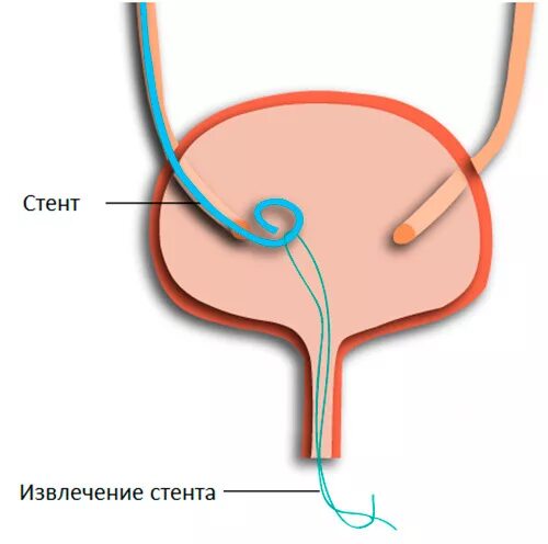 Трубочку в мочевой пузырь