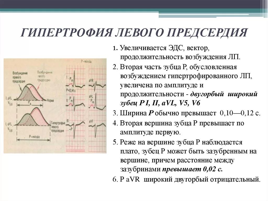 Гипертрофия левого предсердия левого желудочка