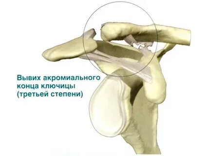 Разрыв связок акромиально ключичного сочленения