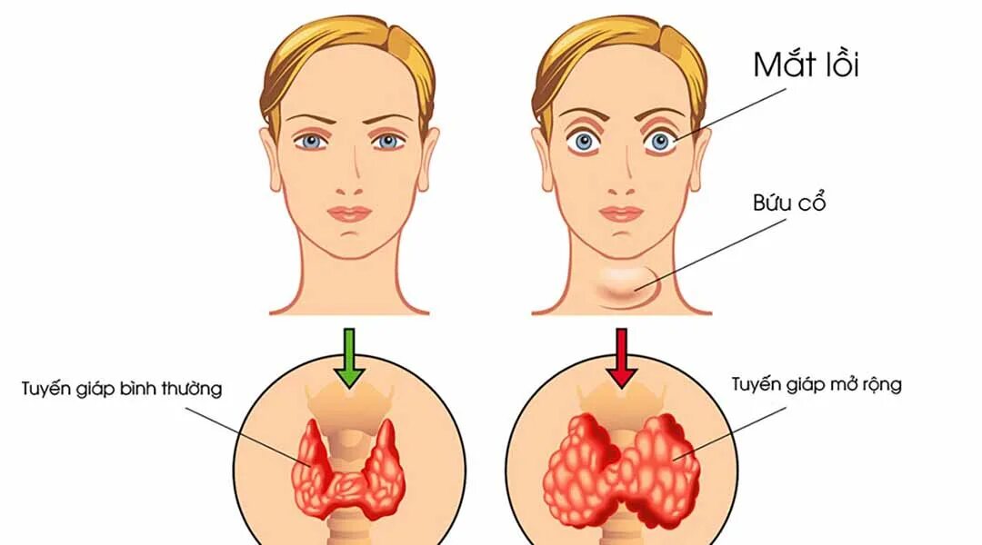 Гипертиреоз dr md ru. Гипертиреоз щитовидной железы. Гипертиреоз и тиреотоксикоз.