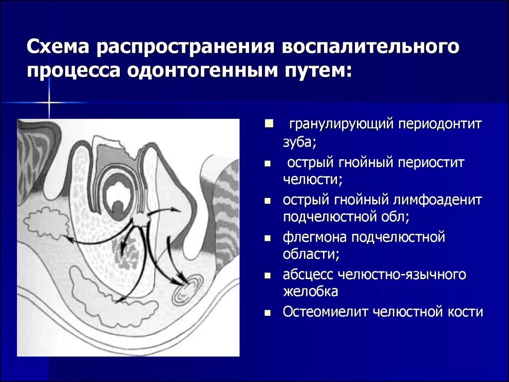 Одонтогенный процесс. Схема распространения воспалительного процесса одонтогенным путем. пути распространения инфекционного процесса при периодонтите. пути распространения одонтогенной инфекции. пути распространения инфекции в чло.