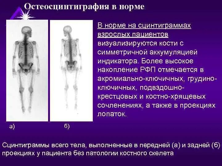 Как называется исследование костей. Остеосцинтиграфия костей скелета норма. аппарат остеосцинтиграфия костей. сцинтиграфия скелета (остеосцинтиграфия). остеосцинтиграфия норма.