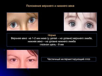 Изменения положения век