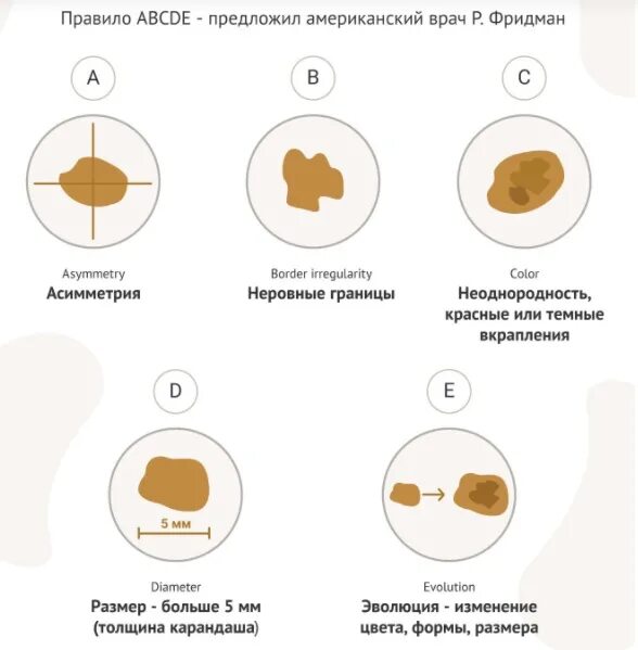 Злокачественные кожные новообразования. Меланоцитарная меланома. Меланома кожи нулевая стадия. О чем говорит количество родинок. О чем говорит количество родинок.