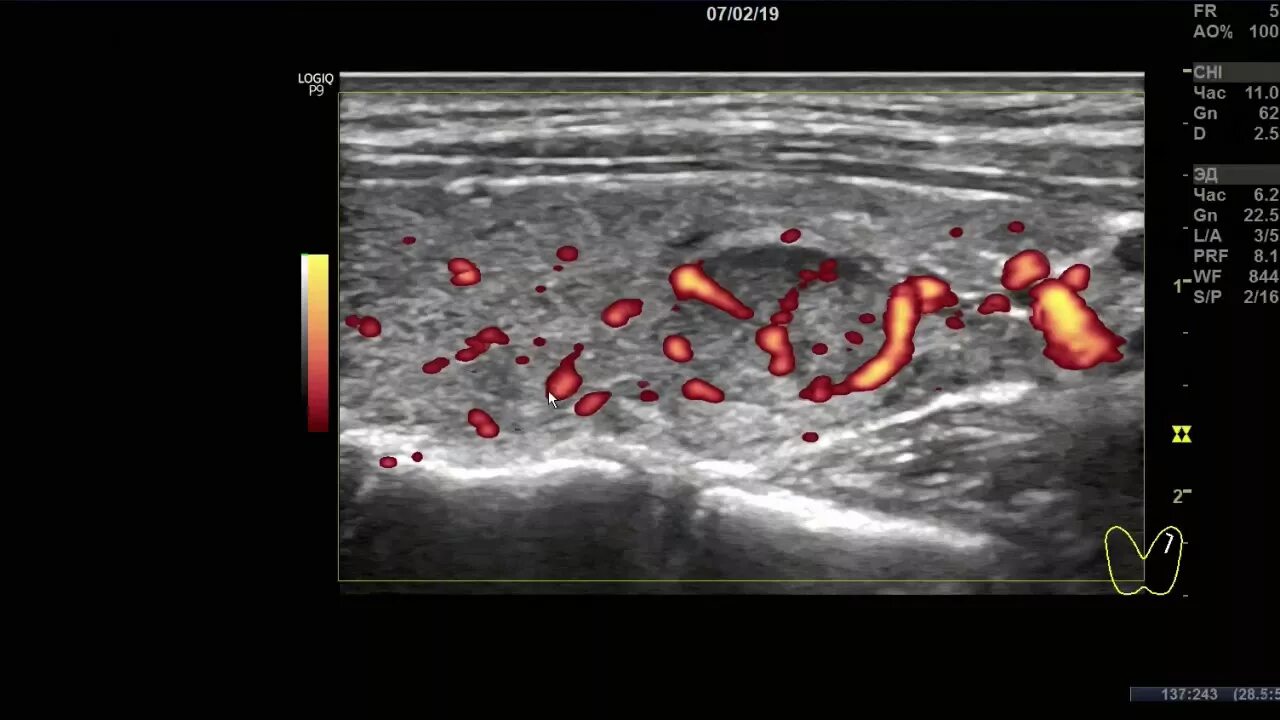 Врач узи обучение ultrasonicthyroid ru. Абсцесс щитовидной железы на УЗИ. Шелестова УЗИ Кулакова. Узлы щитовидной железы доктор Мясников.