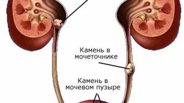 Как болят почки при МКБ: врач рассказала, как бороться с образованием камней? О 