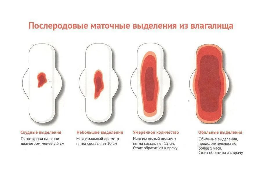 Маточное кровотечение при месячных. Кровеносные выделения.