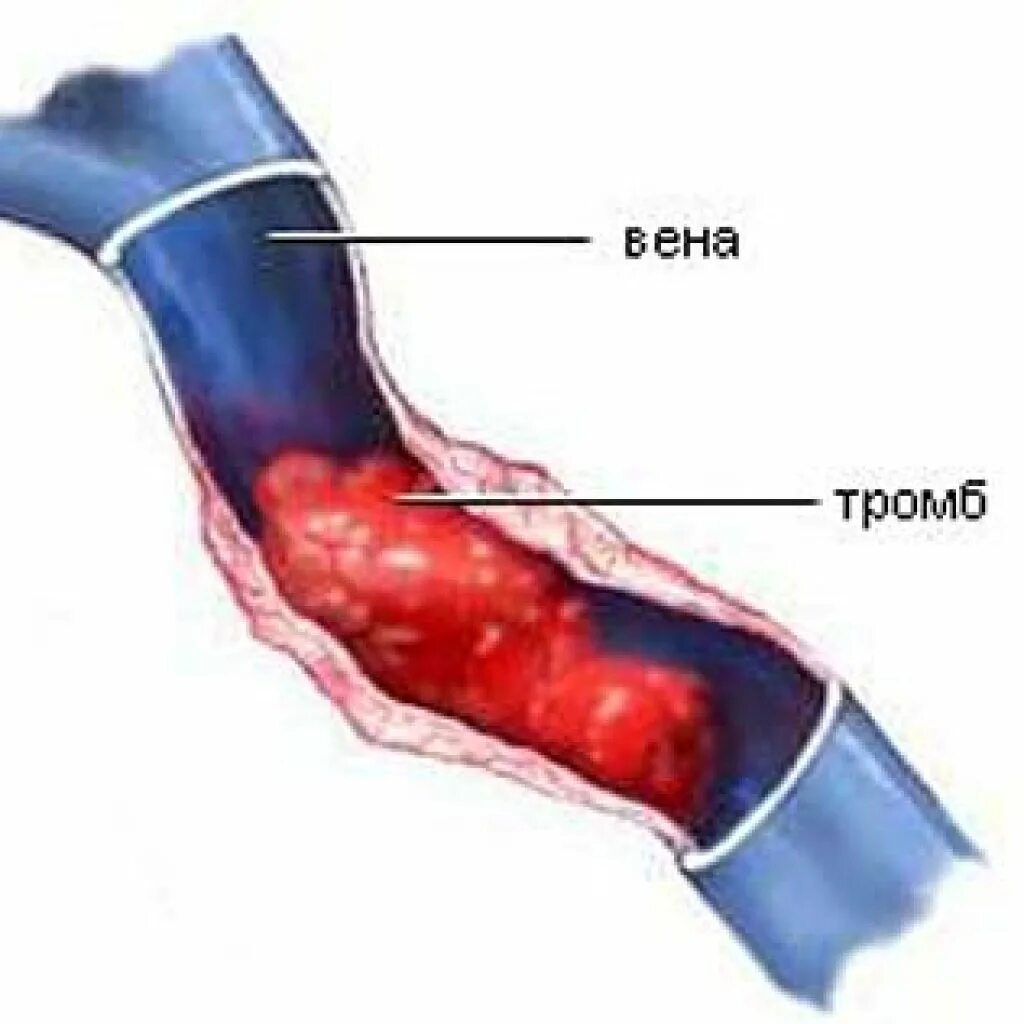 Тромбоз кровотечение. Постинъекционные осложнения тромбофлебит. Флебит – воспаление вены. Воспаление вены с образованием тромба.