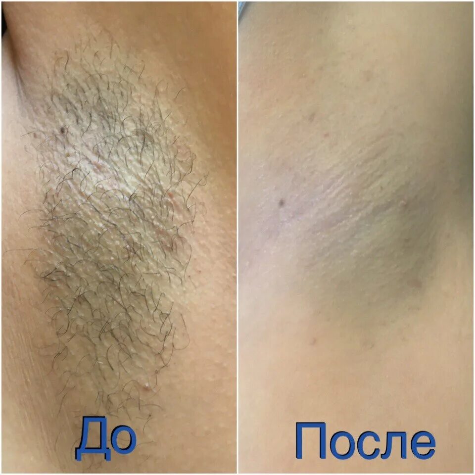 Лазерная эпиляция бикини до и после. Депиляция бикини до и после. эпиляция бикини глубокое. шугаринг глубокое бикини.