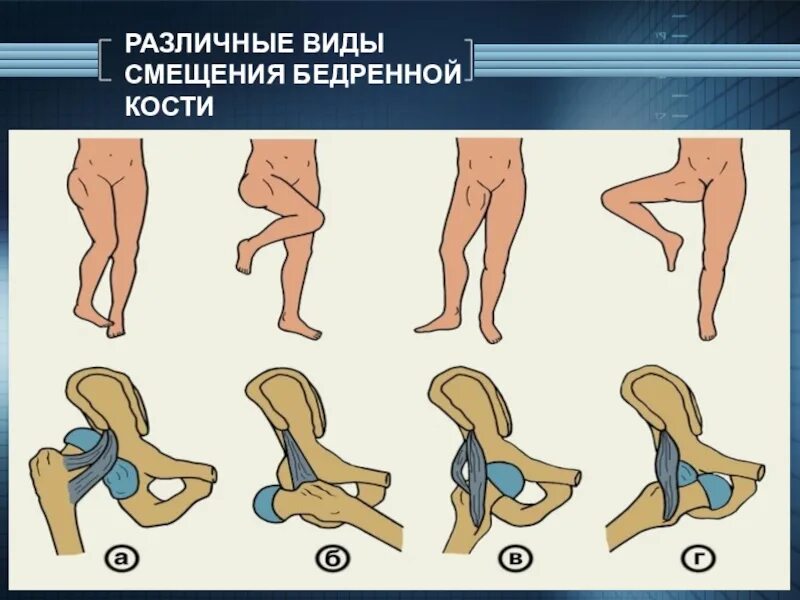 Вывих тазобедренного у взрослых. Задневерхний вывих бедра. задневерхний вывих тазобедренного сустава. задний верхний вывих бедра. осложнения вывиха бедра.