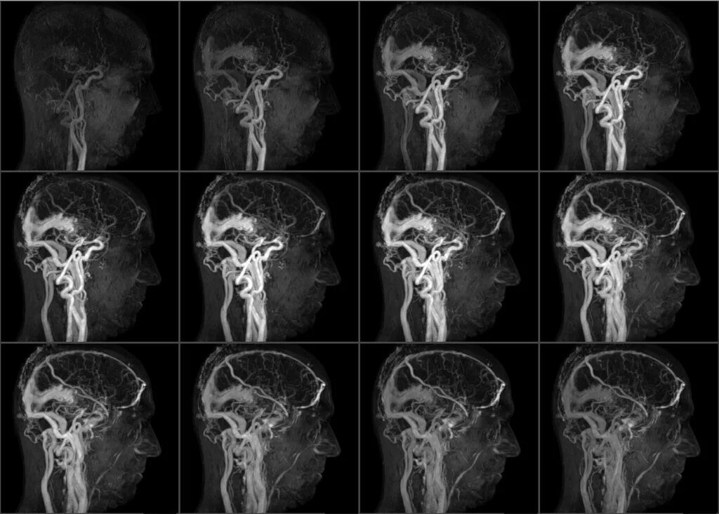Магнитно-резонансная ангиография сосудов головного мозга. Мрт ангиография сосудов головного мозга. Мрт головного мозга с ангиографией. Кт-ангиография артерий шеи и головного мозга. Кт головы москва