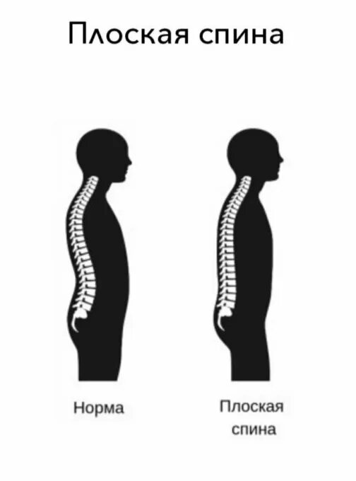 Плосковогнутая спина у детей. Плоская спина. Плоская спина это нарушение осанки. Тип осанки плоская спина.