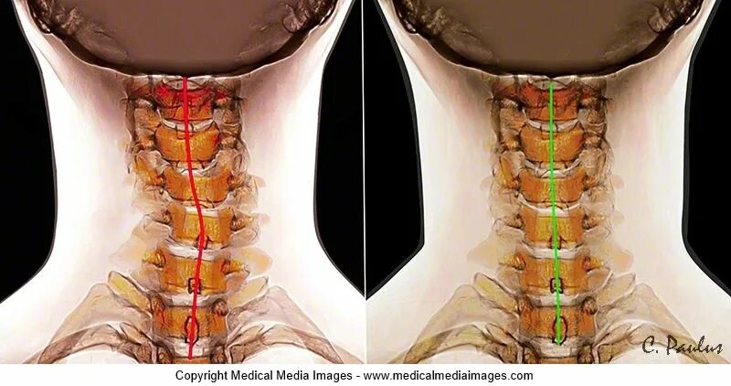 Шейный лордоз кифоз. Кифоз шейного отдела позвоночника рентген. Кифоз и лордоз шейного отдела. S образная шея. S образная шея.