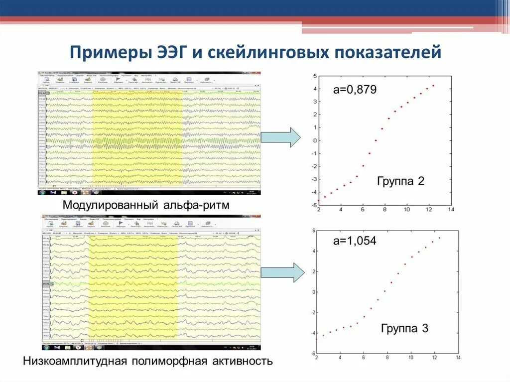 Низкоамплитудная ээг. Низкоамплитудный бета ритм на ЭЭГ. Полиморфная ЭЭГ. Низкоамплитудный Тип ЭЭГ что это значит. Полиморфная активность на ЭЭГ что это.