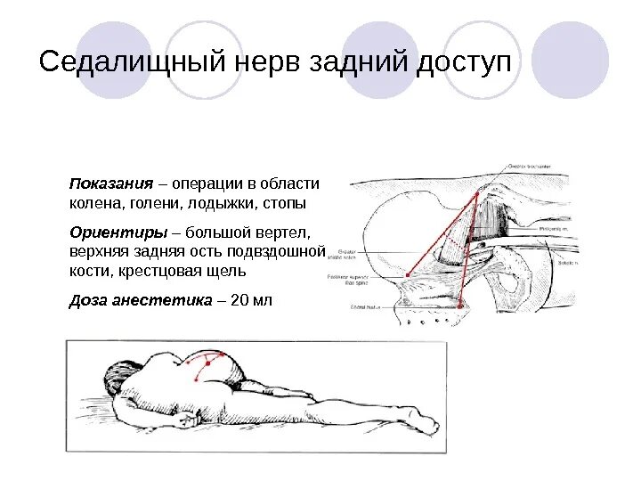 Блокада при защемлении седалищного. Блокада седалищного нерва задним доступом. Проводниковый блок седалищного нерва. Проекционная линия седалищного нерва на бедре. Блокада сидалищногоьнерва.