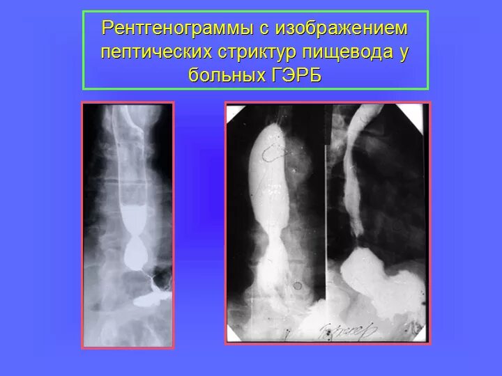 Стеноз пищевода симптомы. Послеожоговые стриктуры пищевода рентген. рентгенодиагностика стриктур пищевода. пептическая стриктура пищевода рентген. рубцовая стриктура пищевода рентген.