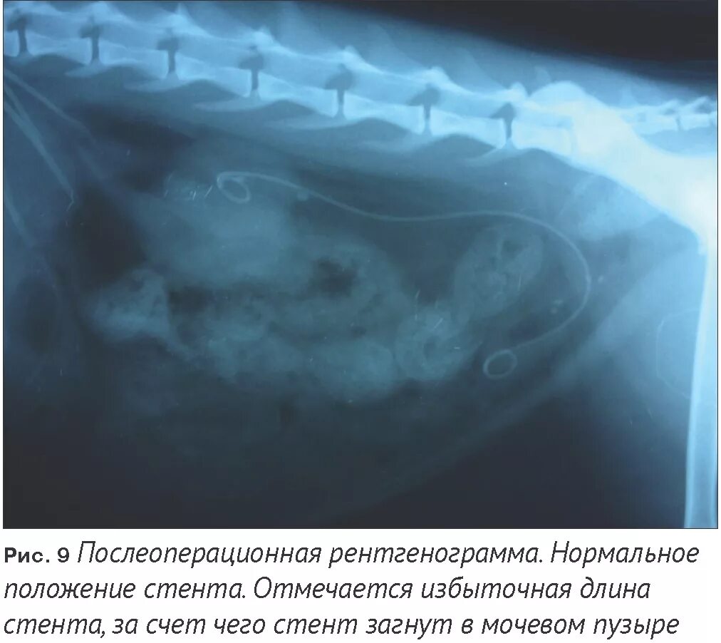 Стент в мочеточнике у женщин. Стентирование мочевого пузыря. Мочеточниковые стентирование.