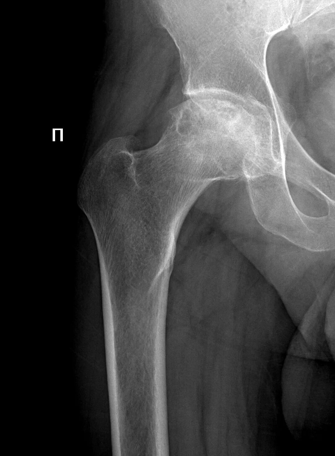 ТБС рентген асептический некроз. Некроз головки бедренной кости рентген. Асептический некроз тазобедренного. Некроз шейки бедра