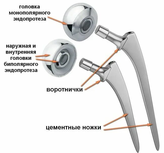 Эндопротезирование тазобедренного сустава как спать. Однополюсный биполярный эндопротез тазобедренного сустава. двухполюсный эндопротез тазобедренного сустава. тазобедренный эндопротез зиммер. биполярное эндопротезирование тазобедренного сустава.