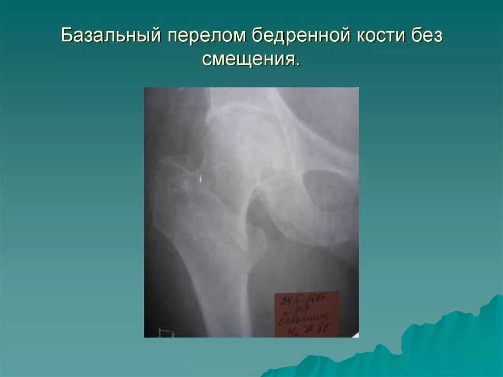 субкапитальный перелом шейки бедренной кости. перелом шейки бедра презентация. субкапитальный перелом шейки бедренной кости. базальный перелом бедра. базальный перелом бедра.