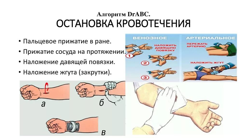 Остановка наружного кровотечения алгоритм. Способы остановки кровотечения артериального кровотечения. Остановка наружного кровотечения алгоритм Сестринское дело. Капиллярное кровотечение остановка ПМП. Повреждение мелких артерий кистей и стоп