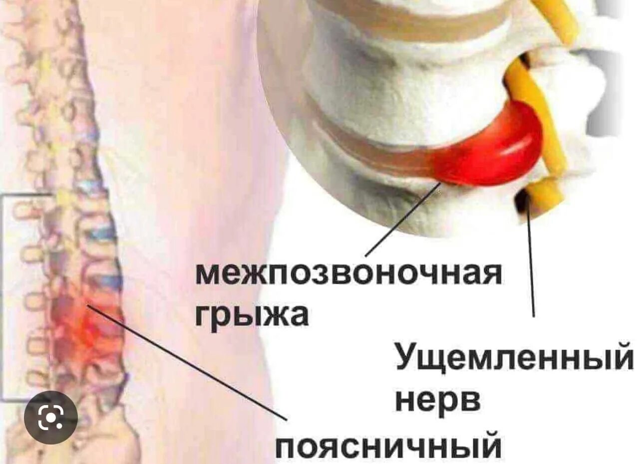 Межпозвонковая грыжа поясничного лечение. Межпозвоночная грыжа. Грыжа поясничного отдела. Спинная грыжа. Грыжа позвоночника поясничного отдела.