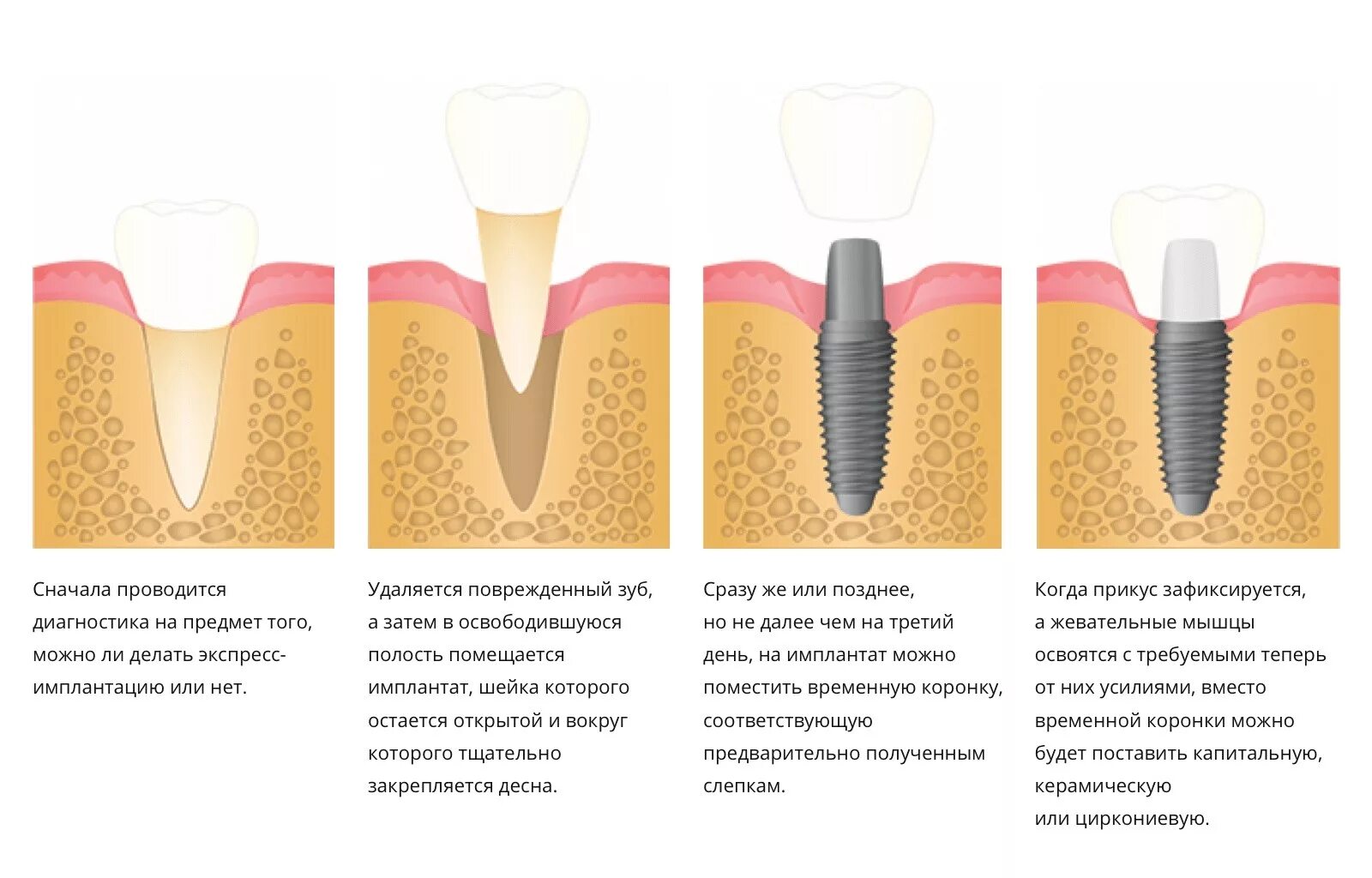 Через сколько можно вставлять зубы. Костная ткань имплантация зубов. Импланты зубов наращивание костной ткани.