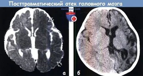 Мрт отек