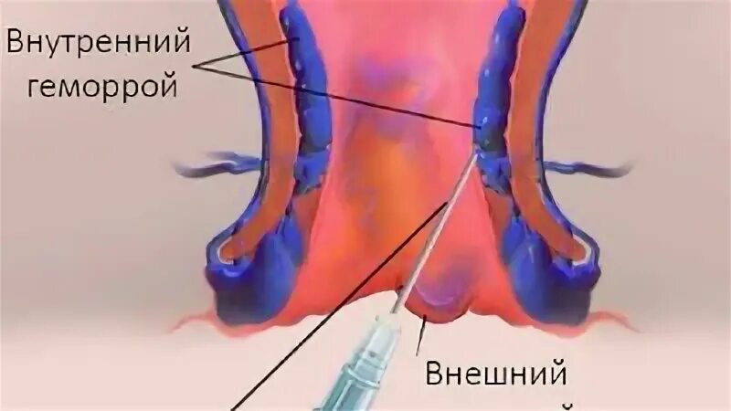 Температура при геморрое