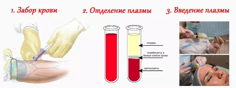 Забор крови для плазмолифтинга. Забор крови плазмолифтинг. Инъекции обогащенной тромбоцитами плазмы. Плазма крови в лицо