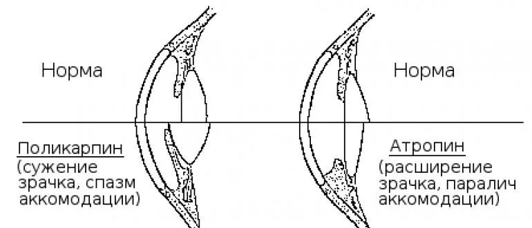 Парез аккомодации. Паралич аккомодации схема. Паралич аккомодации глаза. Спазм аккомодации и паралич аккомодации. Парез и паралич аккомодации.