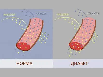 Сахар в норме инсулин