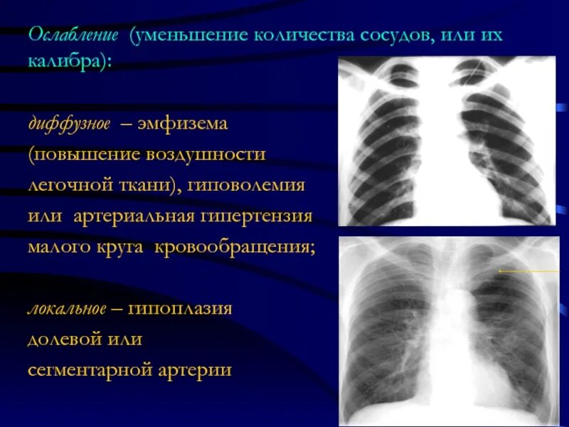 Гиперволемия легких на рентгене. Гиповолемия малого круга. Пороки с гиповолемией малого круга. Гиповолемия малого круга. Врожденные пороки сердца с перегрузкой малого круга кровообращения.
