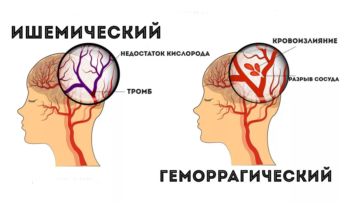 Ишемический и геморрагический инсульт. Энсулат. Геморрагический инсульт и ишемический инсульт. Инсульт картинки. Тромбы после инсульта