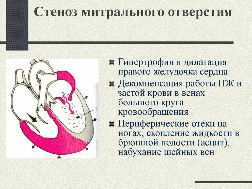 Дилатация правых отделов. Дилатация правого желудочка. Дилатация желудочков сердца. Гипертрофия и дилатация левого желудочка. Приобретенные пороки сердца.