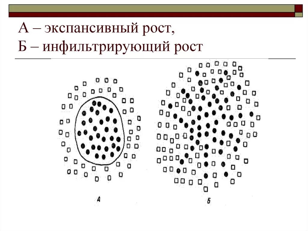 Экспансивный рост опухоли схема. Схема вид опухолей при различных формах роста. Виды опухолевого роста схема. Экспансивный характер роста опухоли. Экспансивный рост это