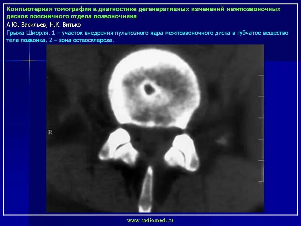 Мрт признаки дегенеративных изменений