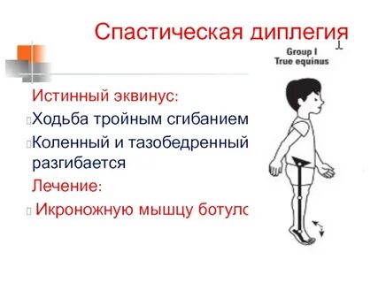 Спастическая диплегия