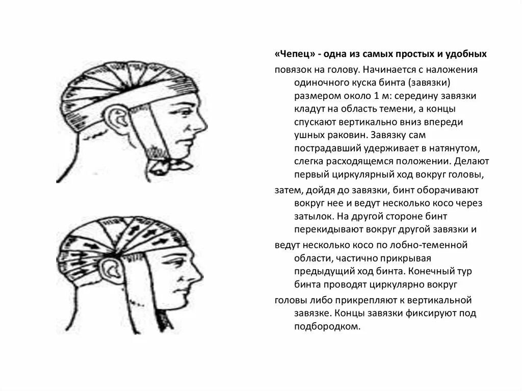 Как перевязывать голову. Схема наложения повязки чепец. Наложение повязки чепец алгоритм. Схема перевязки головы чепец. Техника наложения повязки чепец алгоритм.