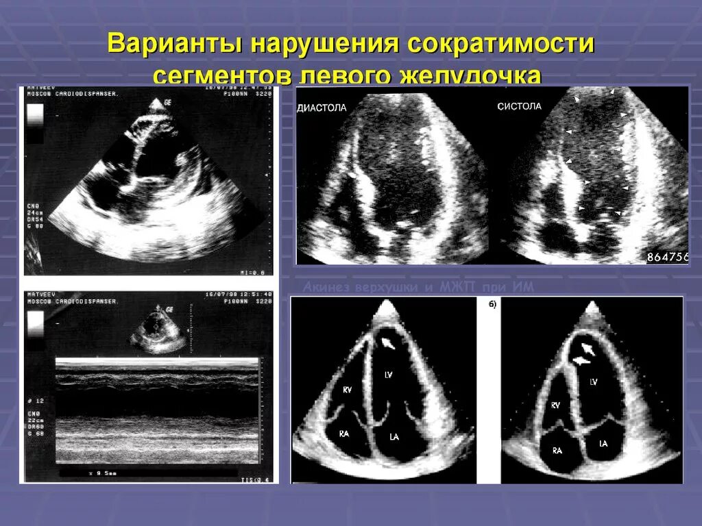 Локальная сократимость левого желудочка. Аневризма верхушки лж ЭХОКГ. Сегменты лж на ЭХОКГ. Зоны гипокинеза ЭХОКГ. Стенки лж на ЭХОКГ.